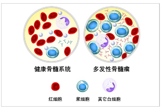 健康骨髓系统VS多发性骨髓瘤.png