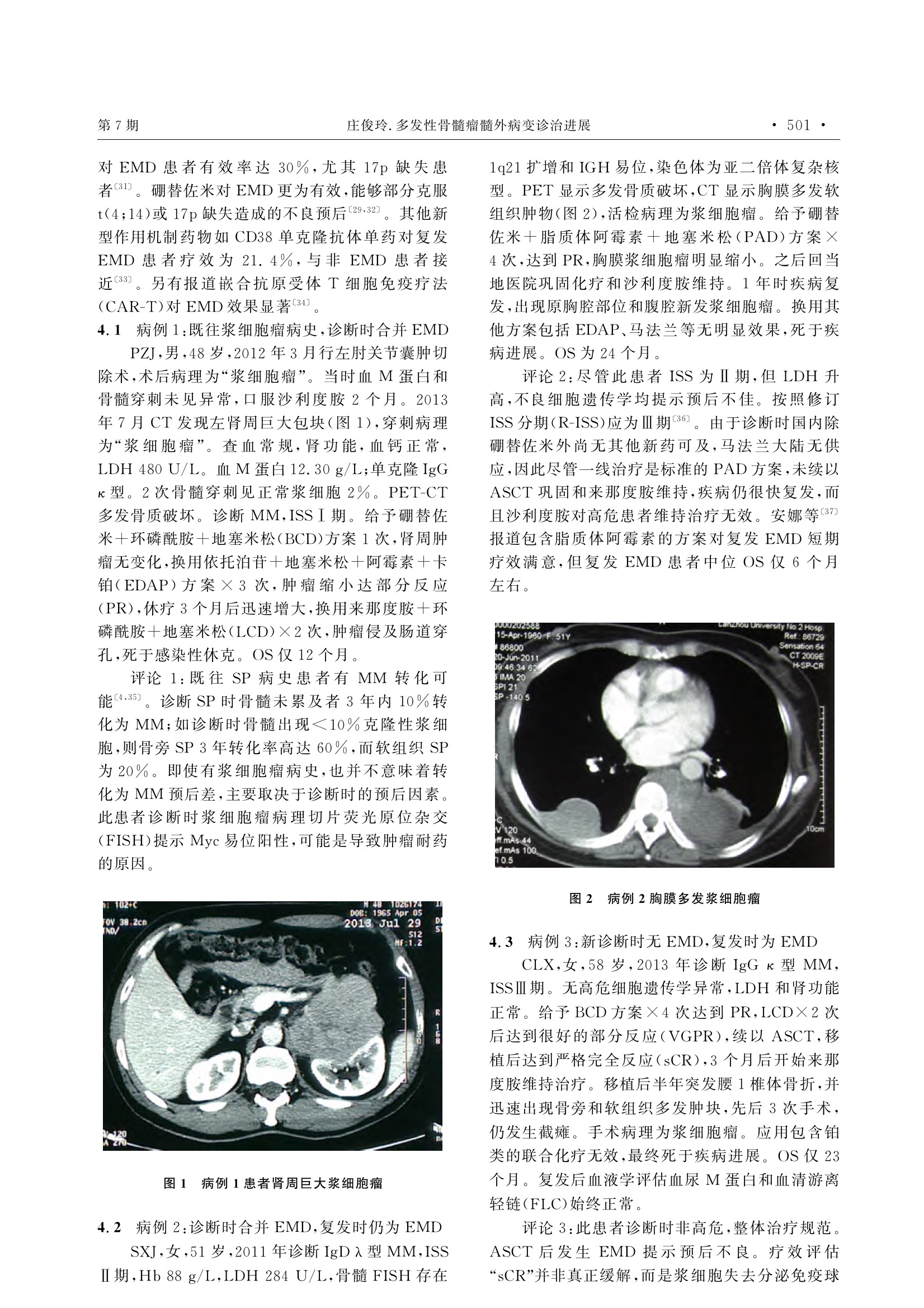 多发性骨髓瘤髓外病变诊治进展 3.jpeg